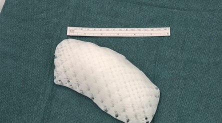 Image for Brisbane team creates world-first 3D printed chest implant