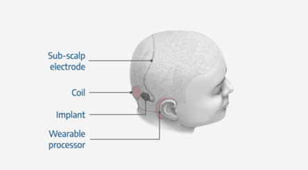 Image for Epi-Minder device tracks epilepsy seizures
