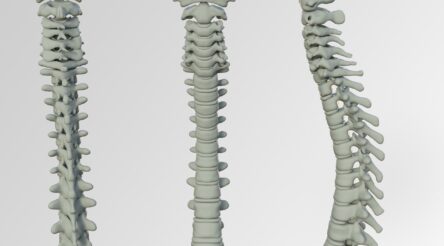 Image for dorsaVi develops new spinal sensor tech with Medtronic