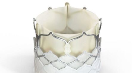 Image for Anteris Technologies reveals trials data of its aortic valve replacement