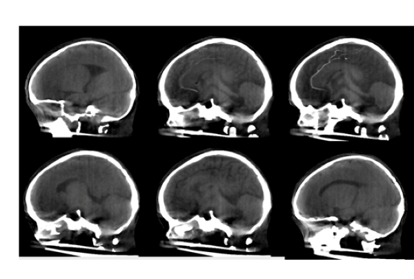 Micro-X's first 3D images from micro Head CT scanner